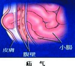 小肠换气_360百科 小肠容易